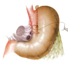 gastroplastia.jpg